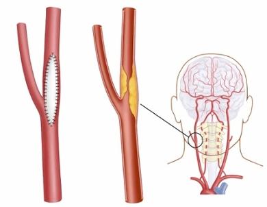 颈动脉内膜切除术贴片闭合.